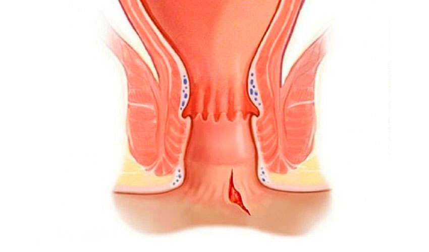 1591614005_anal-fissures.jpg 1591614005_anal-fissures.jpg